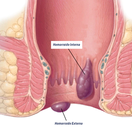 HEMORROIDE